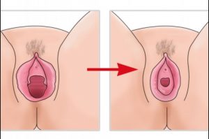himenoplastia1